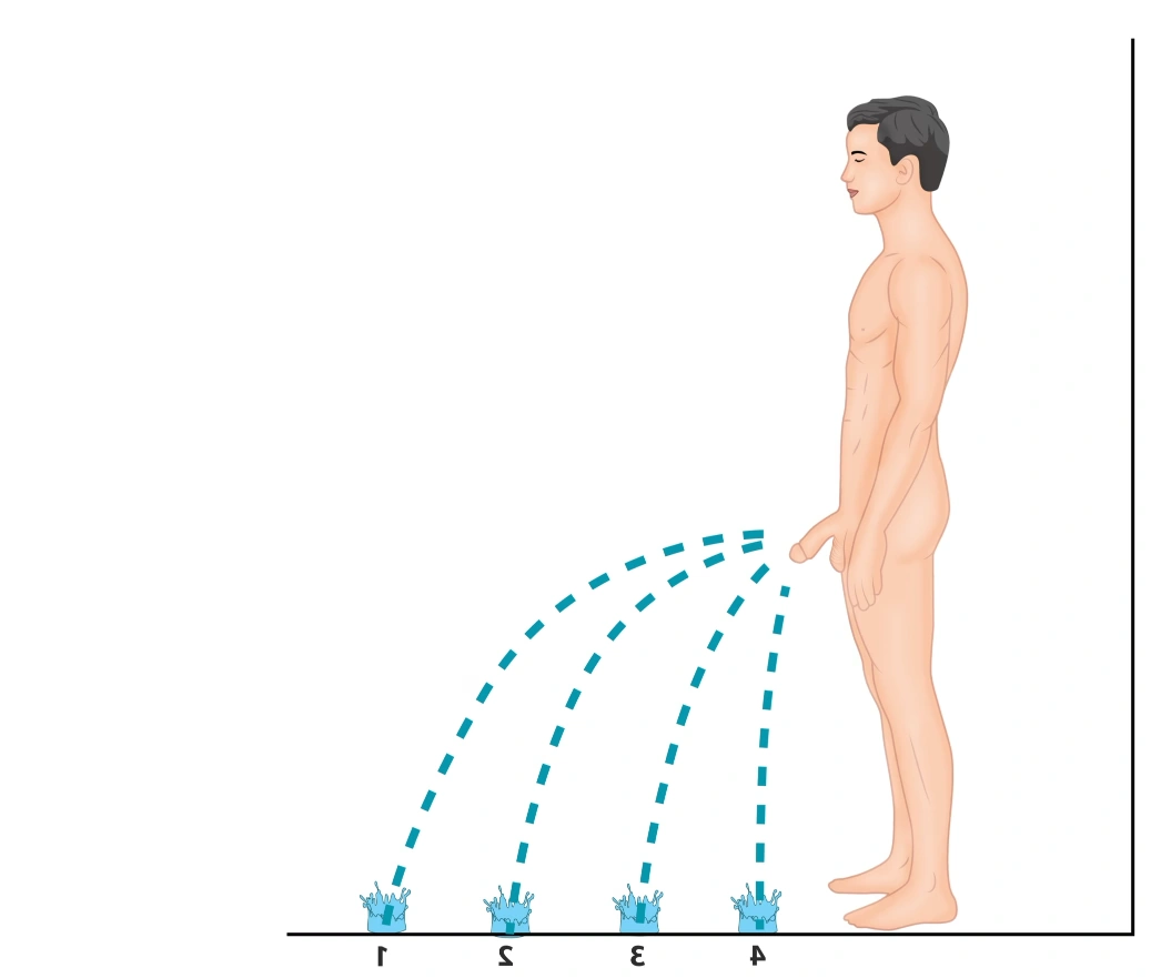 Urethral stricture showing progressive decrease in urinary flow from grade 1 to 4 severity — schematic representation of weak urinary stream correlating with degree of urethral narrowing.