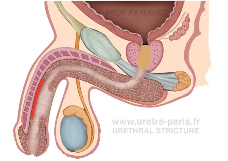 Detailed surgical diagram of the first stage of a two-stage urethroplasty for penile urethral stricture using buccal mucosa graft, illustrating graft placement and preparation for staged urethral reconstruction, highlighted in red