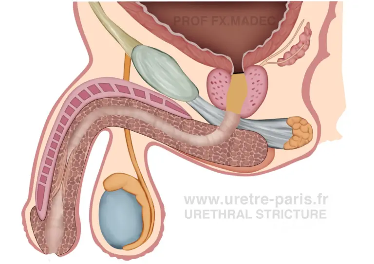 Long penile urethral stricture frequently encountered after failed hypospadias repair, illustrating a complex urethral reconstruction scenario